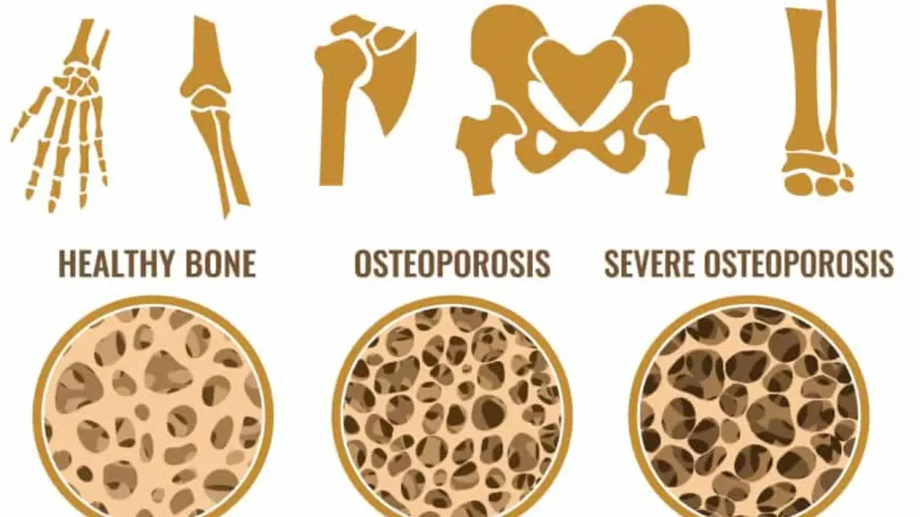 Treatment for Osteoporosis